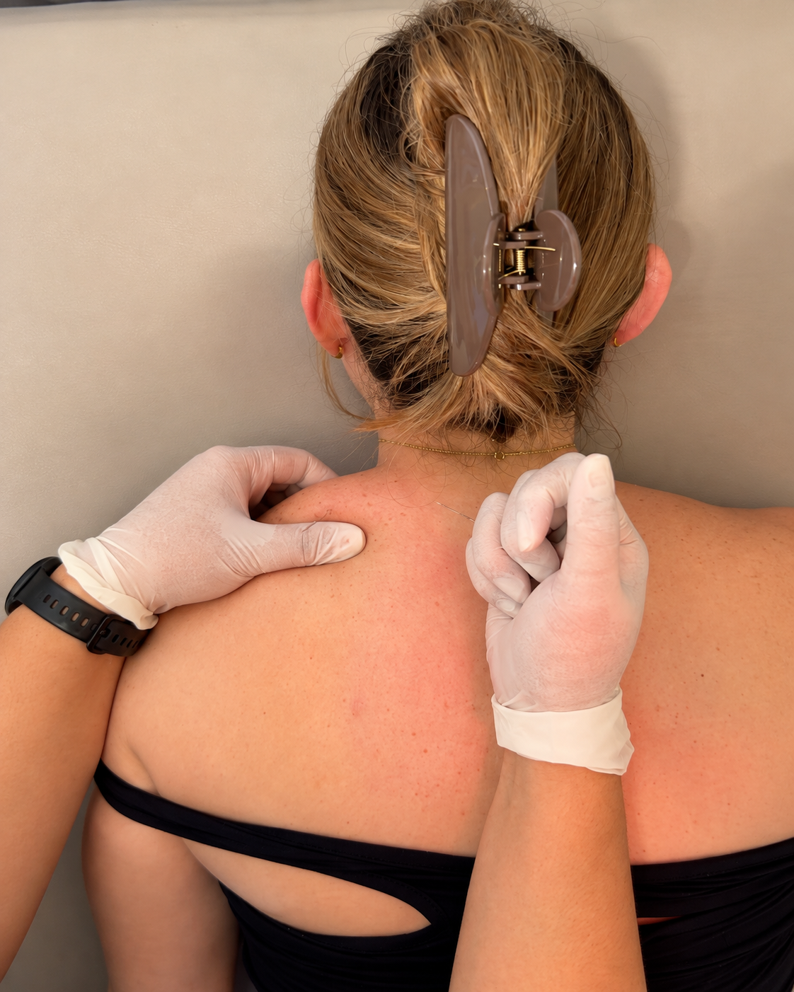 Dry needling at Forge Lab Physiotherapy Clinic